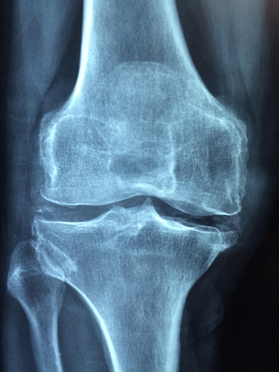 Arthrose & Arthritis in Düren