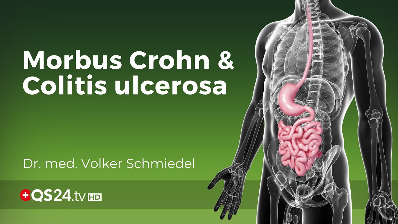 Morbus Crohn Düren - Chronische-Darmerkrankung - Ganzheitliche Darmtherapie - Holistisches Darmgleichgewichts-Coaching.